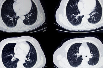 A CT scan of a lung